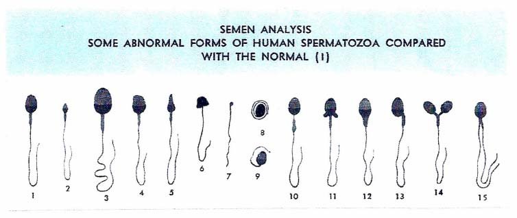 male-infertility-sperm-anal male infertility sperm analysis