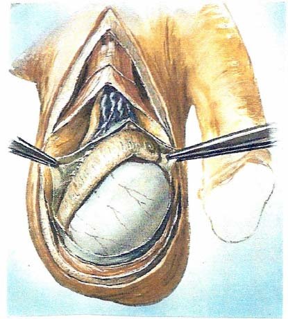 Cancer of the Testis